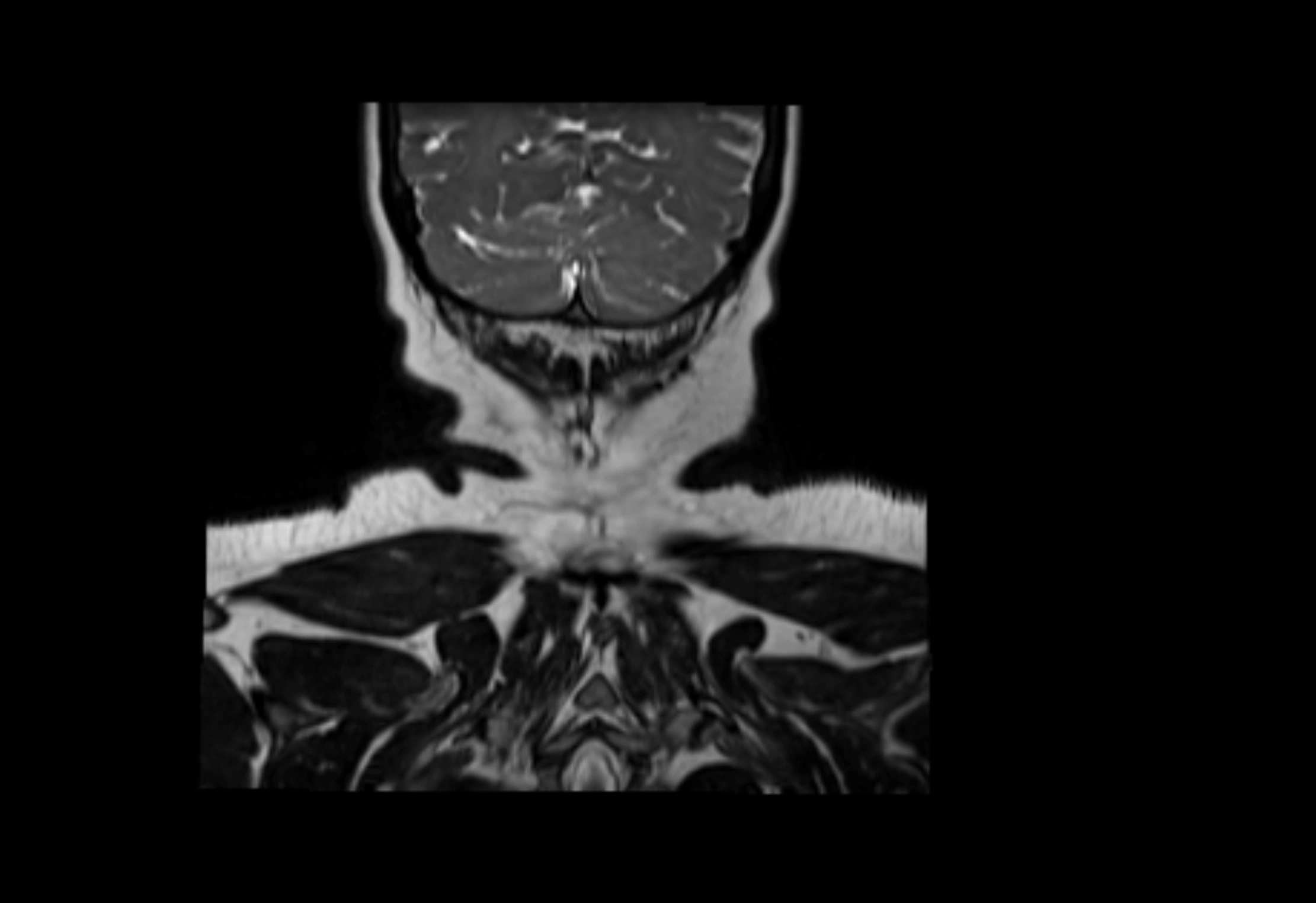 Neck coronal lymph node cross sectional MRI anatomy 3T MRI  image-img-00001-00005.webp